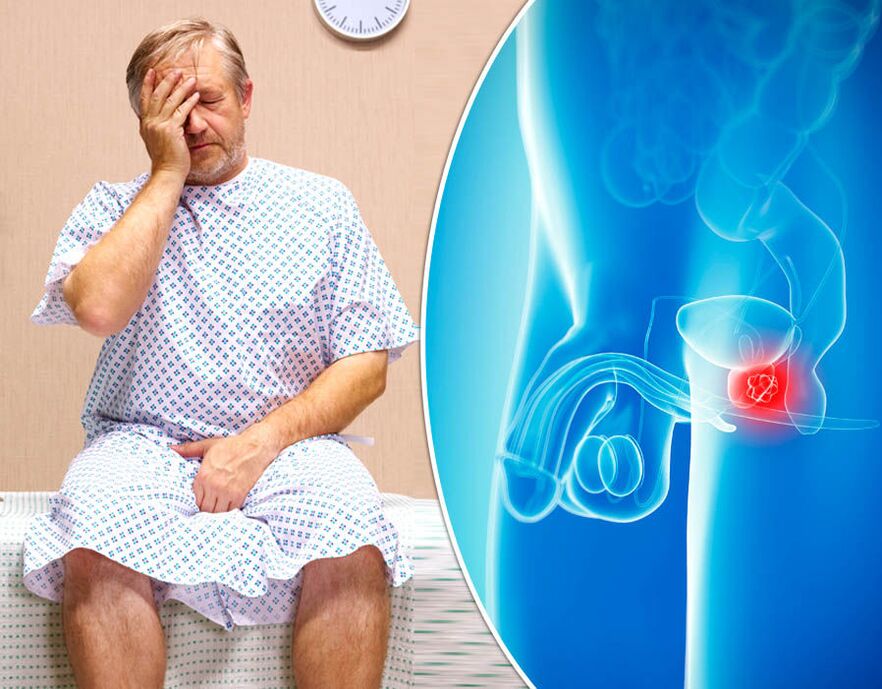 A man with prostatitis was diagnosed with the disease