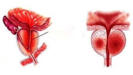Chronic prostatitis looks like
