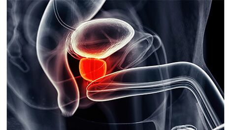 Prostatitis