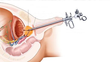 Treatment of prostatitis surgery